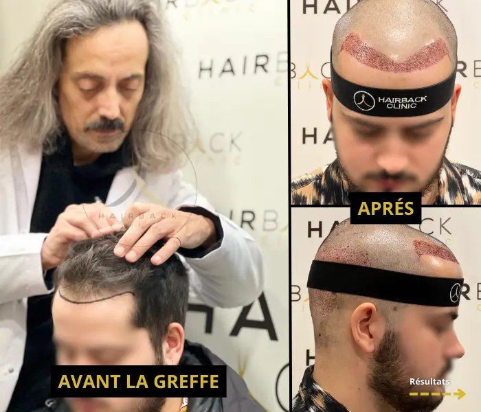 2000 à 2500 greffons avant/après 1 pré-opératoire greffe de 2000 greffons