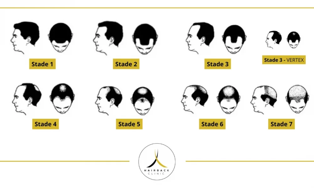Echelle de Norwood-Hamilton : les 7 stades de la calvitie ! 5 Echelle de norwood-hamilton : les 7 stades de la calivite illustré par une planche