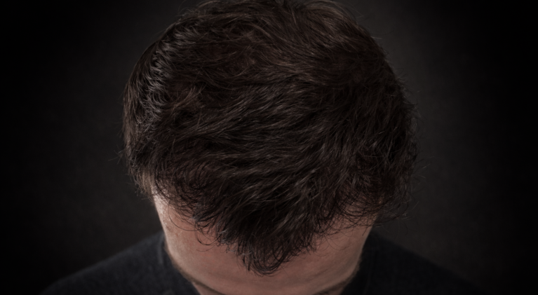 Greffe de cheveux 3100 greffons resultat