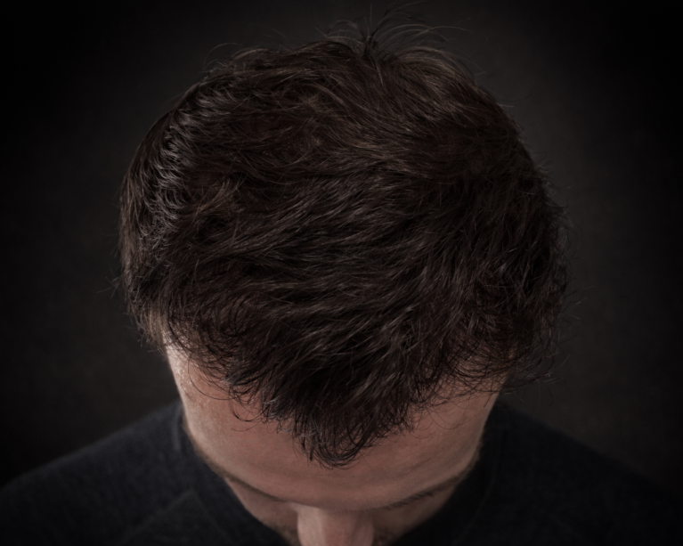 Greffe de cheveux 3100 greffons resultat