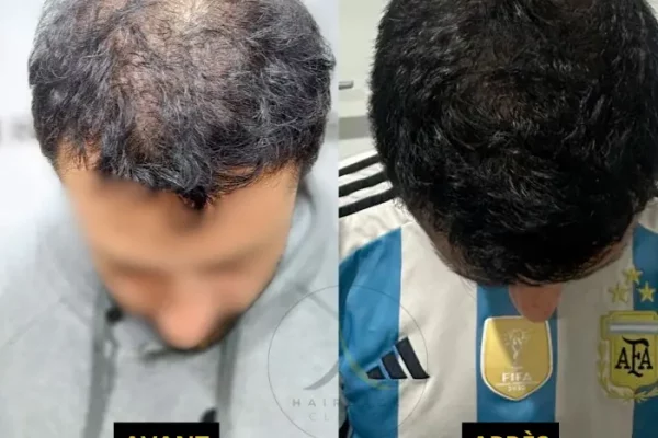 Résultat avant après greffe de cheveux en turquie