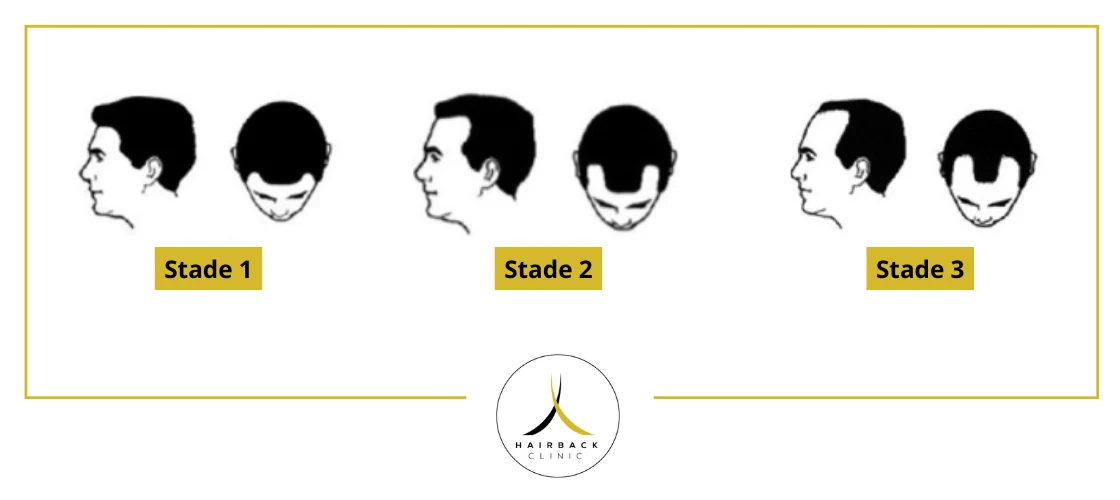 Les stades de la calvitie de 1 à 3 selon l'echelle