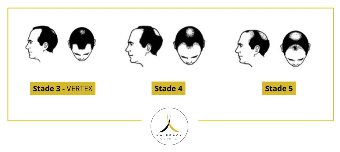 Les stades de la calvitie de 3 vertex à 5 selon l'echelle