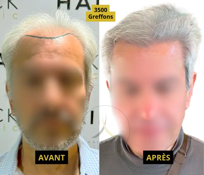 Résultat pour 3500 GREFFONS