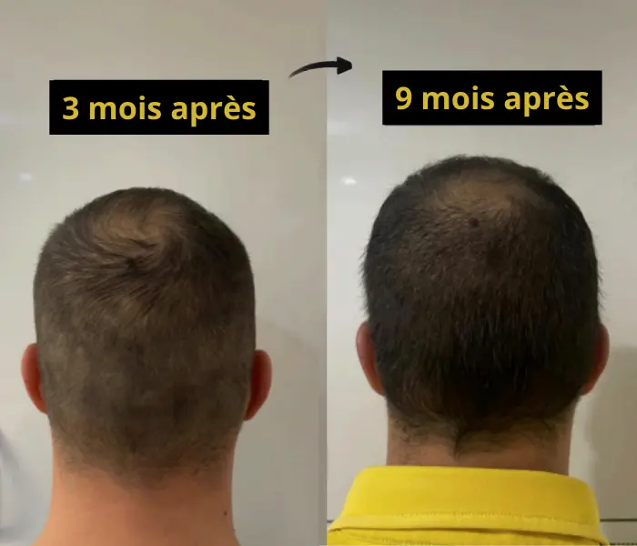 Zone donneuse 3 mois après et 9 mois après