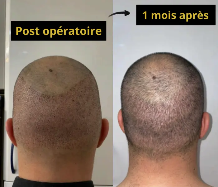 zone donneuse post-opération et 1 mois après