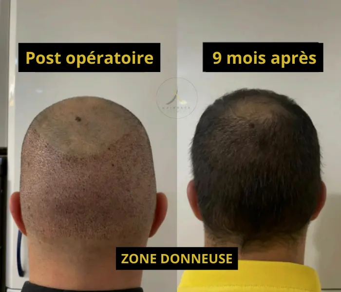 évolution zone donneuse greffe de cheveux post opération et après 9 mois