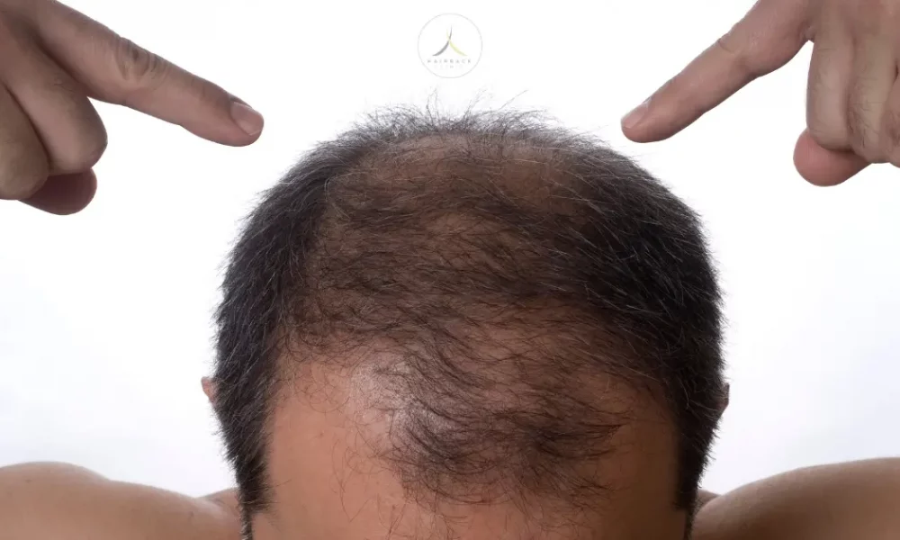 Comment stopper la calvitie sur un crane d'homme dégarni