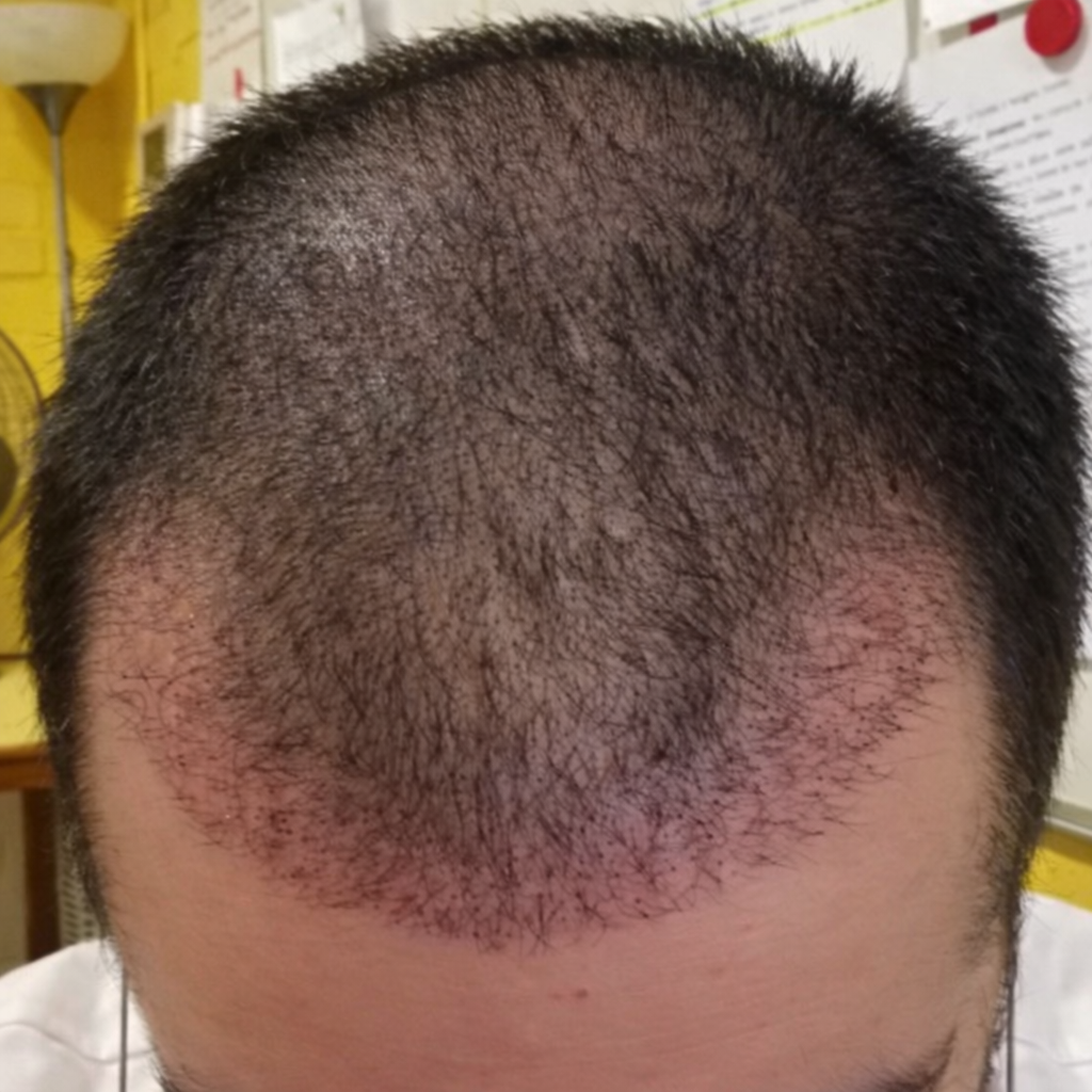 1 mois greffe de cheveux resultat