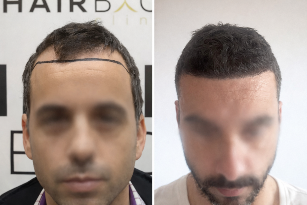 2500 greffons resultat greffe de cheveux