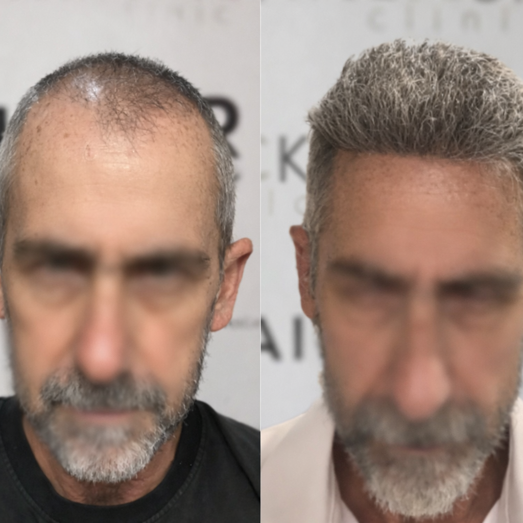 4000 greffons resultat greffe cheveux 1