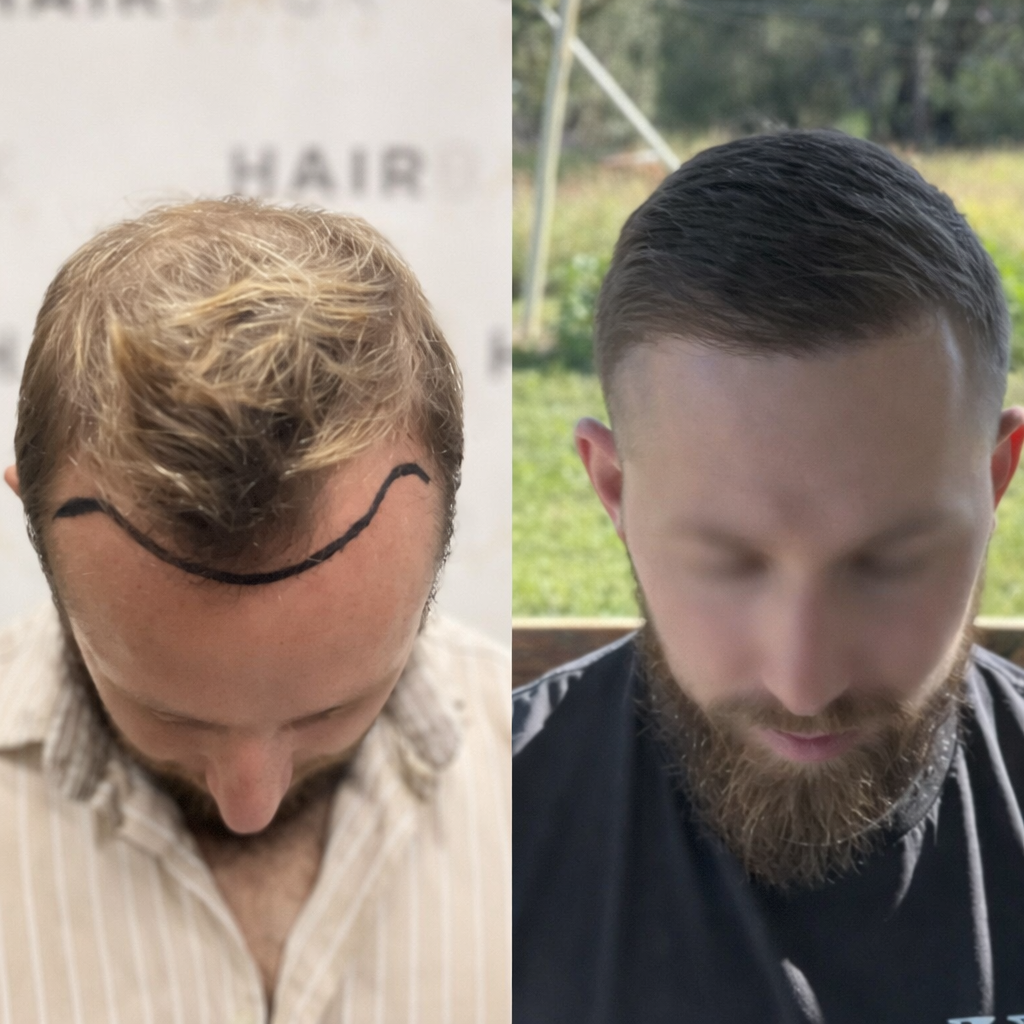 4200 greffons result greffe de cheveux turquie