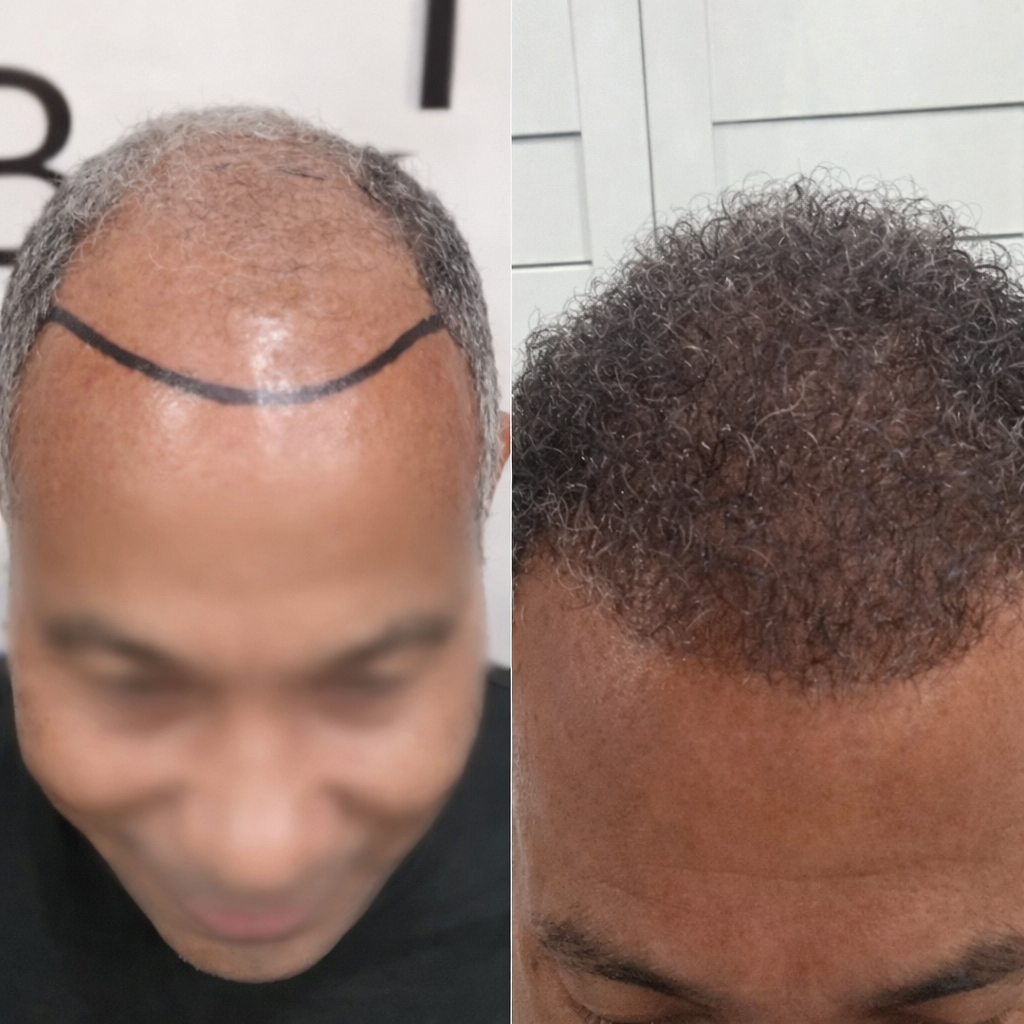4500 greffons greffe de cheveux resultat turquie 1