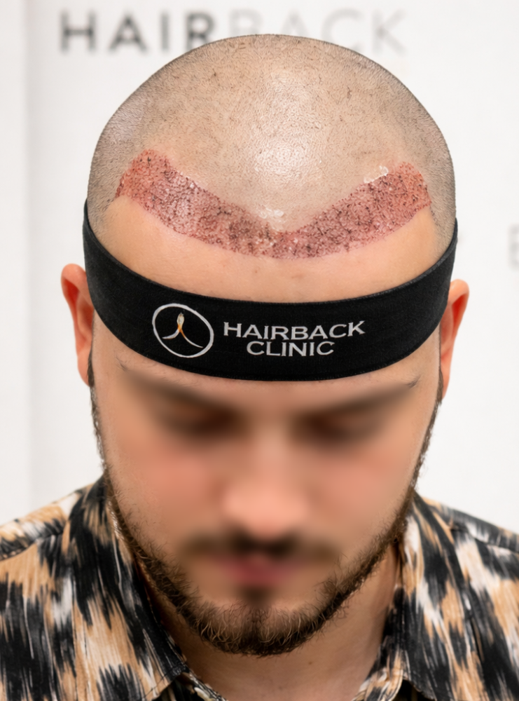 HairBack Clinic - Greffe de Cheveux resultat 2500 greffons 1