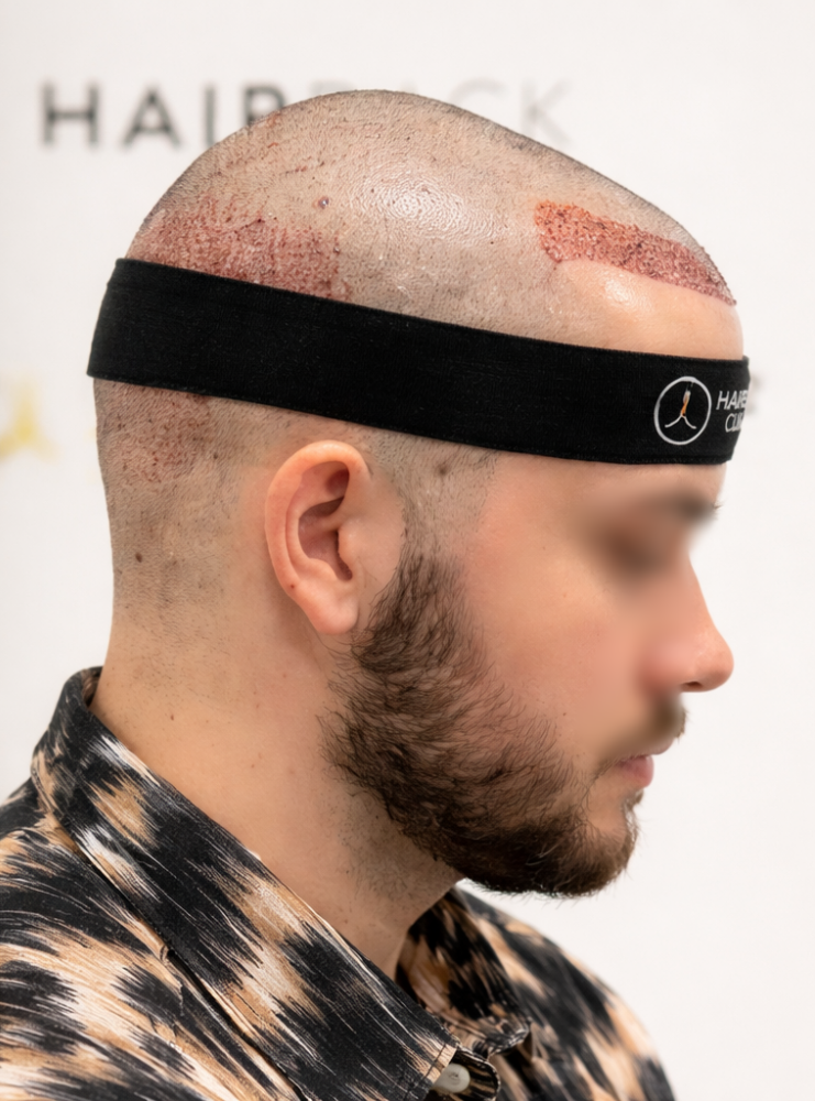 HairBack Clinic - Greffe de Cheveux resultat 2500 greffons 2