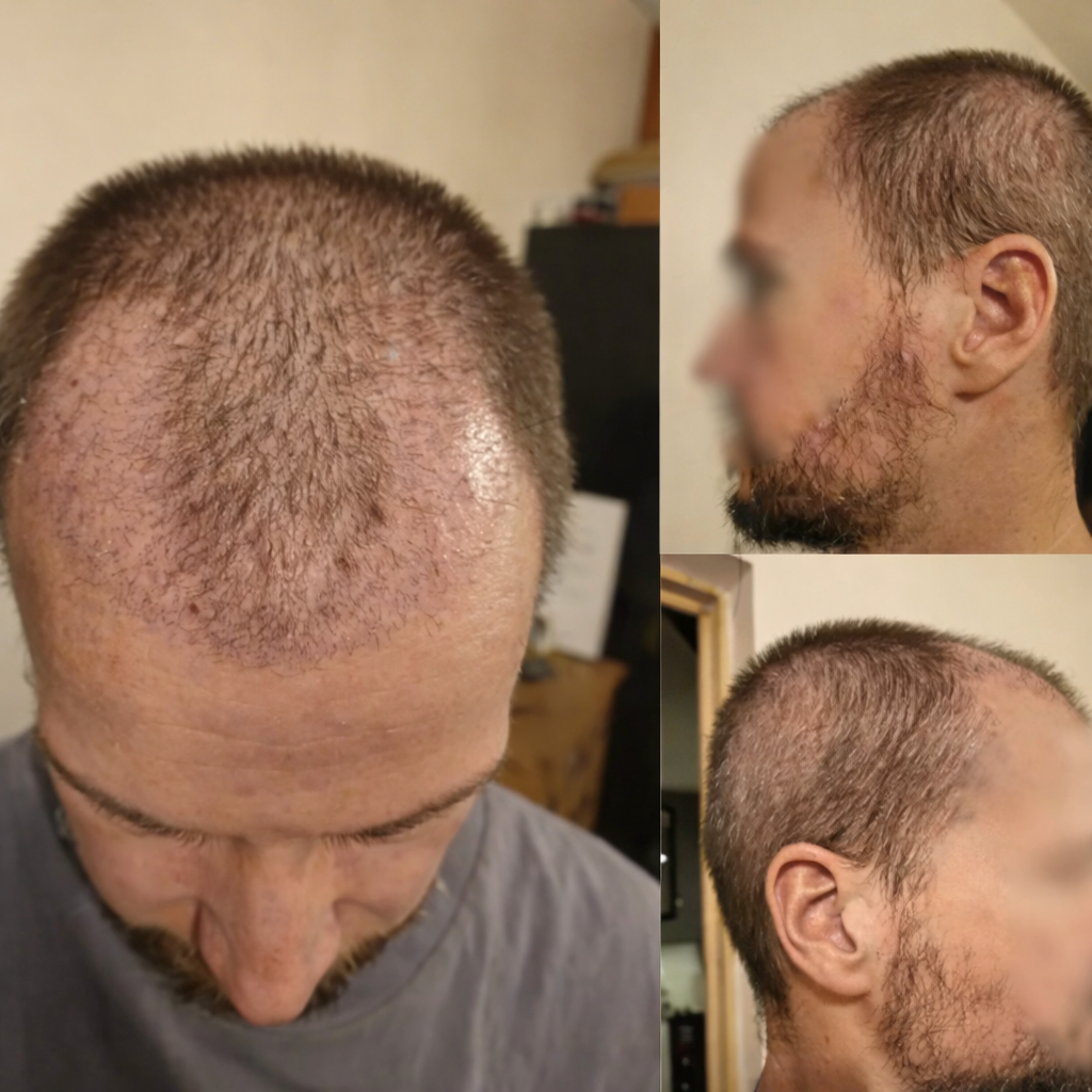 greffe de cheveux en turquie resultat 1