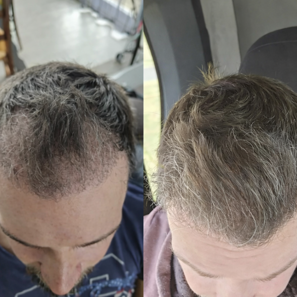 greffe de cheveux en turquie resultat