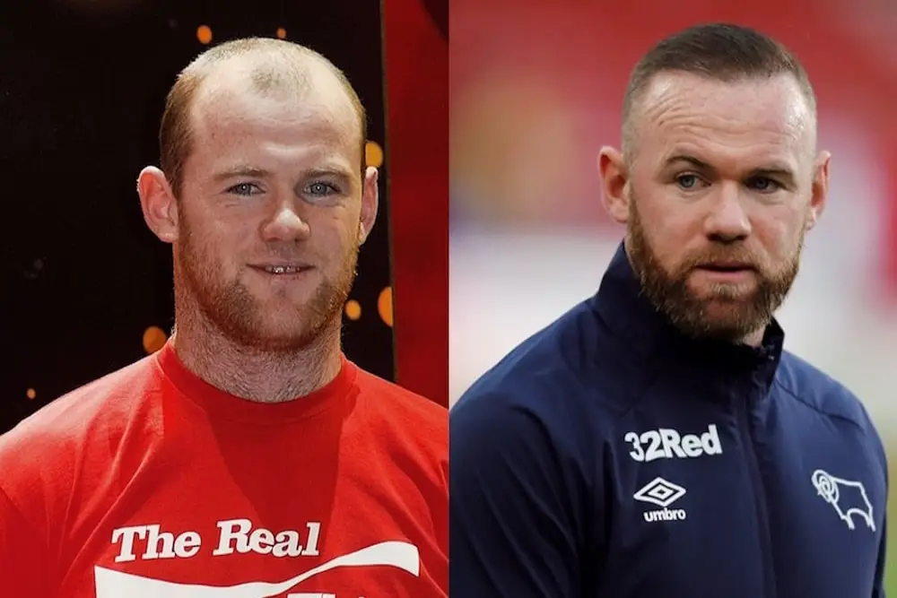 Image - Greffe de cheveux chez les footballeurs célèbres - Wayne Rooney