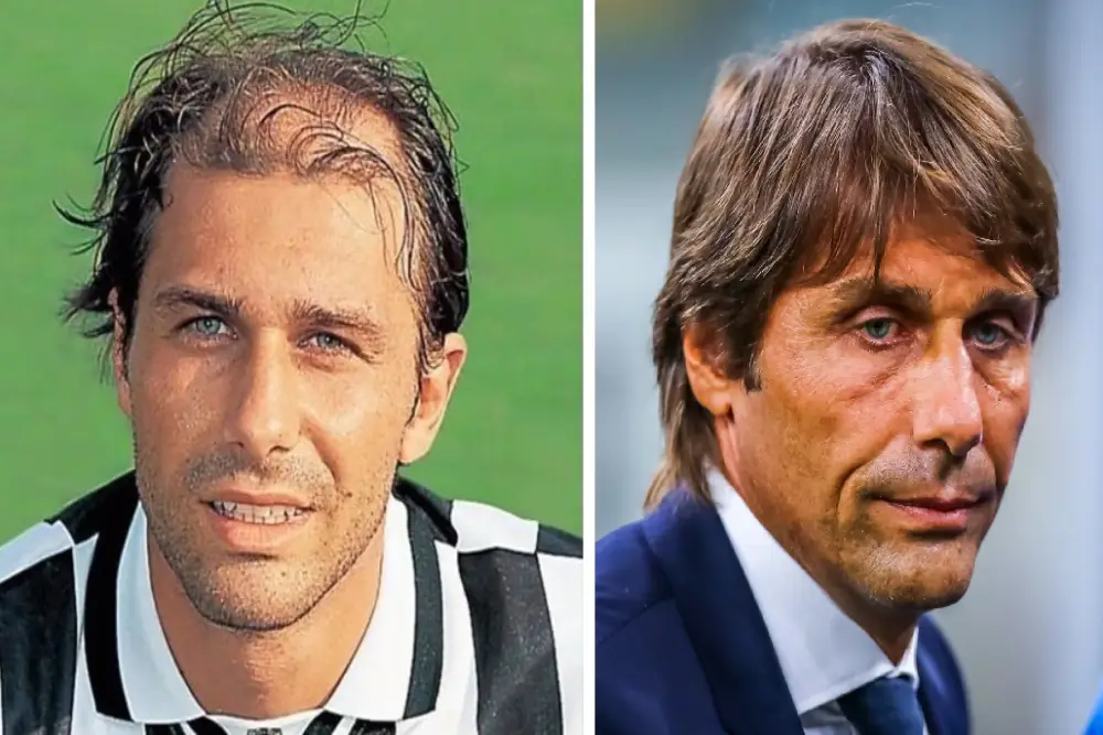 Image - Greffe de cheveux chez les footballeurs célèbres - Antonio Conte