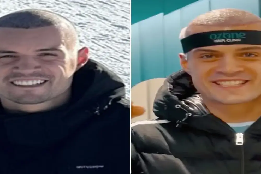 Image Greffe de cheveux chez les footballeurs celebres Granit Xhaka