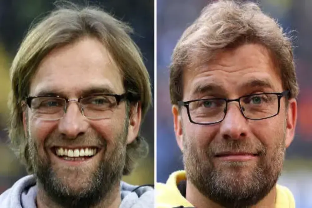 Image - Greffe de cheveux chez les footballeurs célèbres - Jurgen Klopp