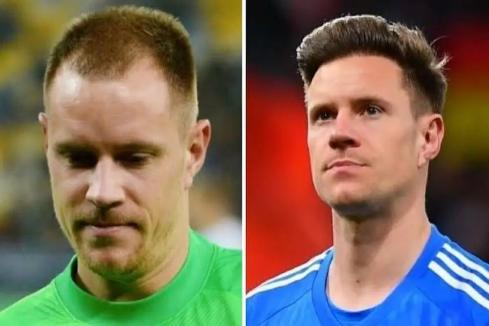 Image - Greffe de cheveux chez les footballeurs célèbres - Marc Andre