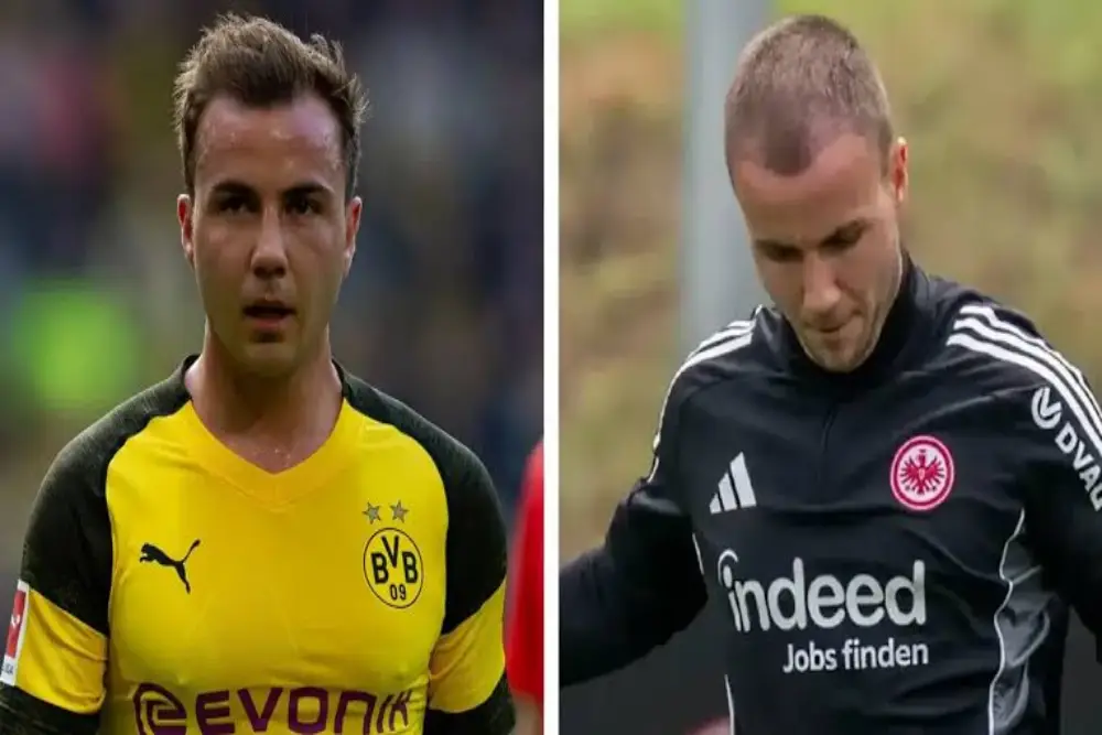 Image - Greffe de cheveux chez les footballeurs célèbres - Mario Gotze